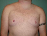 Chest Masculinization