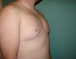 Chest Masculinization