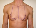 Chest Masculinization