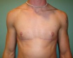 Chest Masculinization