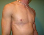 Chest Masculinization