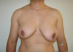 Chest Masculinization Before and After Photos
