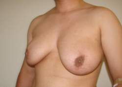 Chest Masculinization