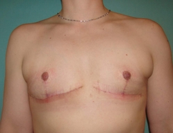 Chest Masculinization