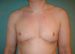 Chest Masculinization