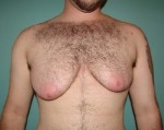 Chest Masculinization