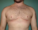 Chest Masculinization