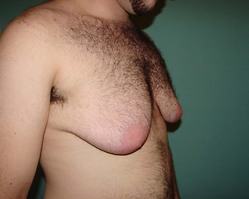 Chest Masculinization