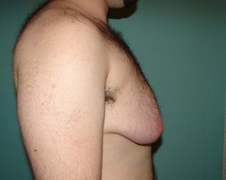 Chest Masculinization