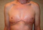 Chest Masculinization Before and After Photos