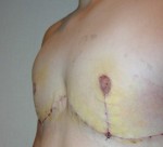 Chest Masculinization Before and After Photos