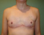 Chest Masculinization Before and After Photos