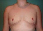 Chest Masculinization Before and After Photos