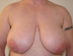 Chest Masculinization