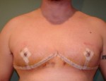 Chest Masculinization Before and After Photos
