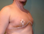Chest Masculinization Before and After Photos