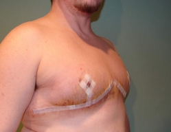 Chest Masculinization