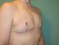 Chest Masculinization