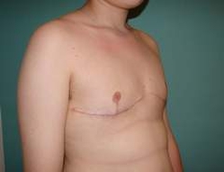 Chest Masculinization