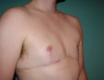 Chest Masculinization Before and After Photos