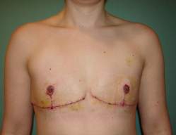 Chest Masculinization
