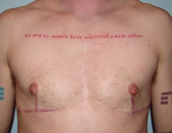 Chest Masculinization