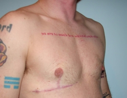 Chest Masculinization