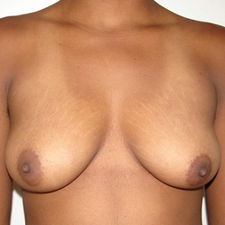 Chest Masculinization