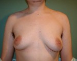 Chest Masculinization Before and After Photos