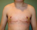 Chest Masculinization Before and After Photos