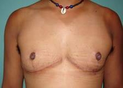 Chest Masculinization